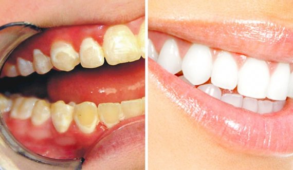 Bëni dhëmbët më të bardhë në shtëpi në vetëm 3 minuta
