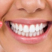 Për buzëqeshje të bardhë: Ja si të hiqni gurët nga dhëmbët