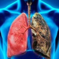 Infeksionet e rënda të frymëmarrjes mund të rrisin rrezikun në mushkëri