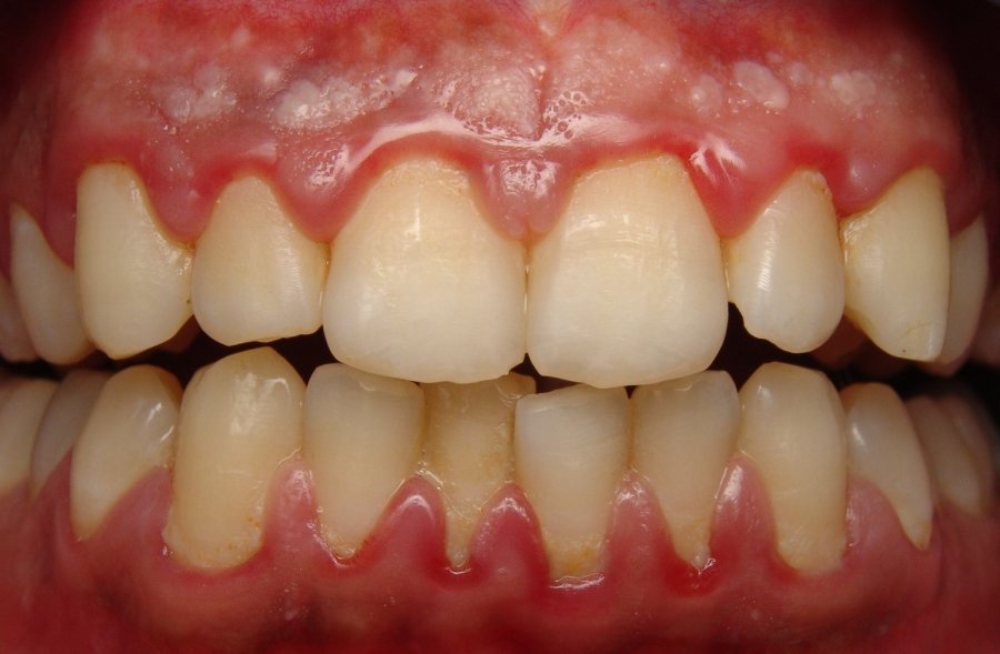 Lidhja midis mishit të dhëmbëve dhe kancerit të vezoreve