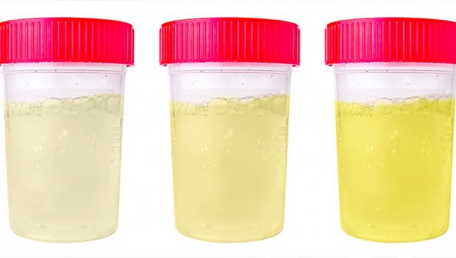 Ngjyra e urinës, pasqyrë e shëndetit tuaj