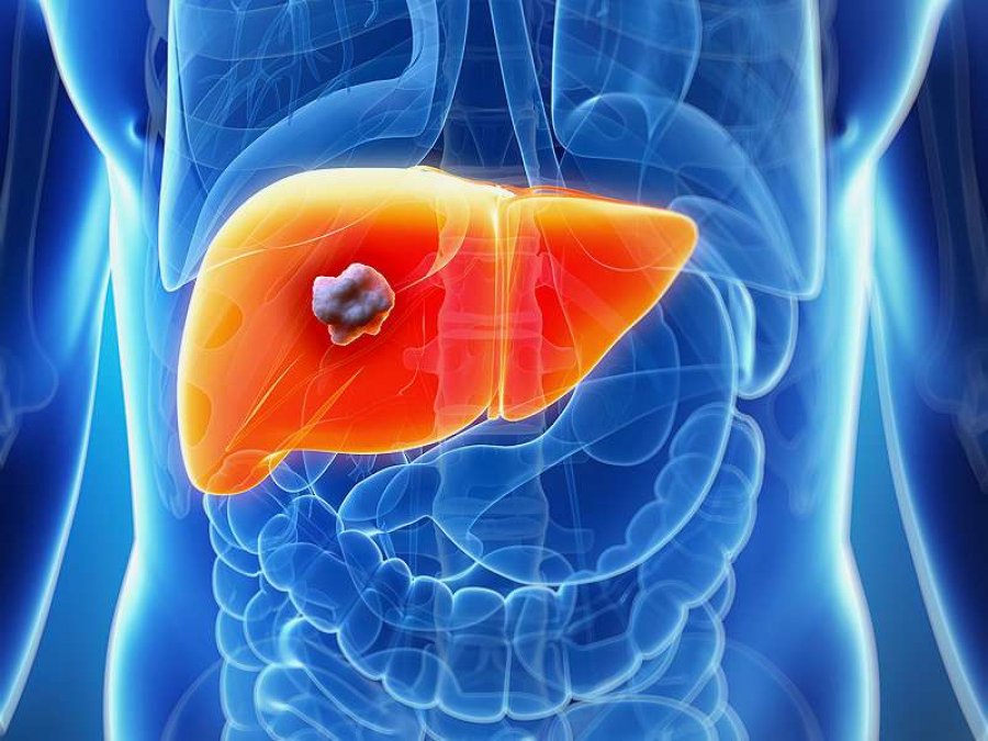 Hepatiti i pashëruar hap rrugën për kancer në mëlçi