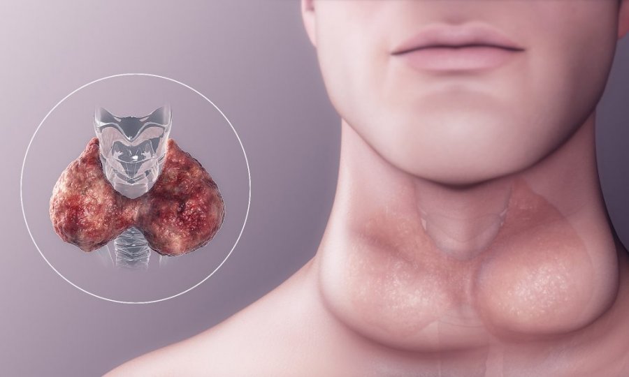 Receta që shëron gjëndrat tiroide