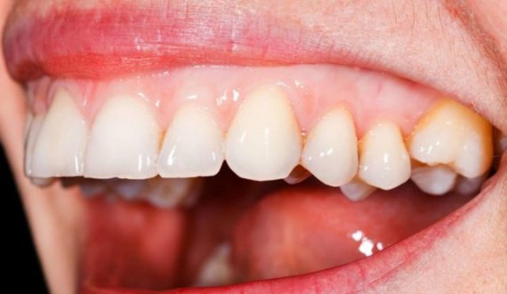  Lidhja e sëmundjeve të mishit të dhëmbëve dhe shtypjes së gjakut