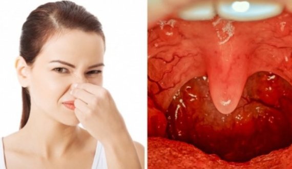 Aroma e keqe nga goja, pasojë e dietës me proteina 