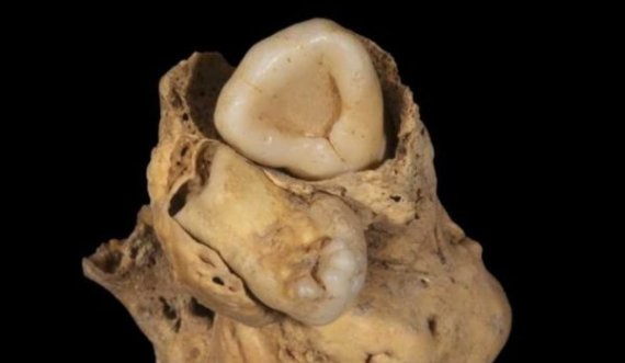 Gjetja e rrallë në trupin e një gruaje të lashtë egjiptiane, zbulohet se vuante nga një tumor i çuditshëm