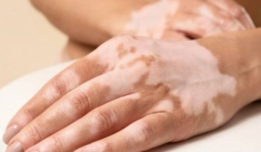 Pse shkaqet e vitiligos nuk janë përcaktuar ende plotësisht?