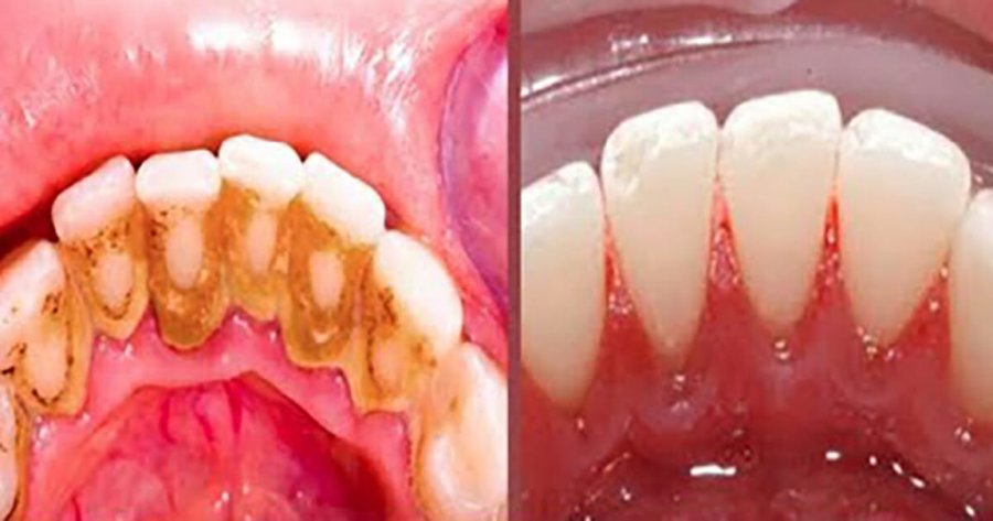 Hiqni pllakën dentare për vetëm 5 minuta