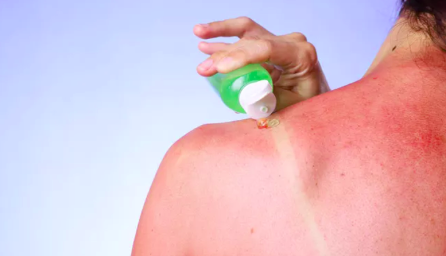 Çfarë nuk duhet të bëni kur digjeni nga dielli në plazh, ja disa këshilla nga dermatologët: Gabimet që mund të përkeqësojnë gjendjen tuaj