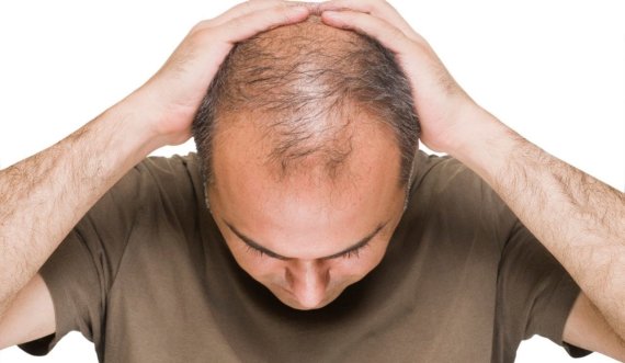 Losioni çudibërës: përgatiteni dhe hiqni qafe tullacërinë