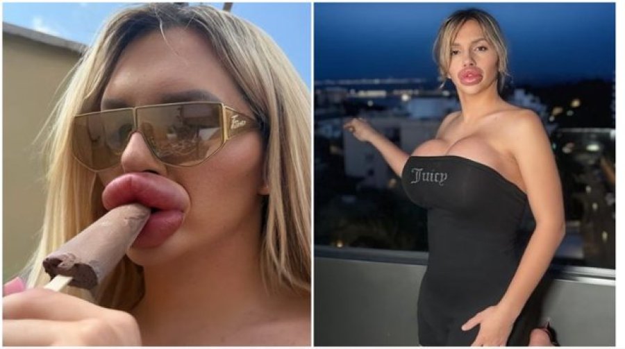 Modelja flet pas ndërhyrjeve plastike: Kam probleme me frymëmarrjen, por për bukurinë ia vlen!