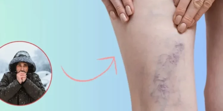 Ja si ndikon i ftohti dhe kushtet atmosferike në vena