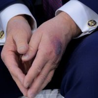 Dora e mavijsour e Trump ndez spekulimet për shëndetin e presidentit