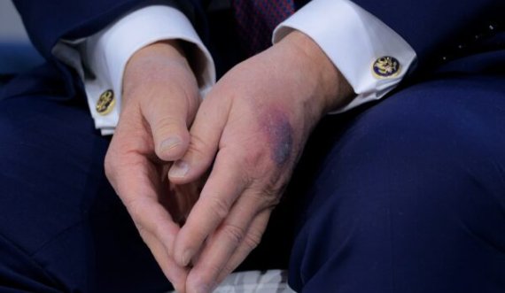 Dora e mavijsour e Trump ndez spekulimet për shëndetin e presidentit