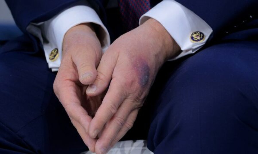 Dora e mavijsour e Trump ndez spekulimet për shëndetin e presidentit